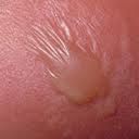 A blister, a circumscribed, fluid containing, elevated lesion of the skin. Usually more than 5mm in diameter.