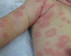Redness of the skin.  Can be a rash.