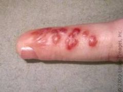 A lesion (whitlow) on a thumb or finger caused by the herpes simplex virus.  Dental personnel are especially vulnerable and can leave you debilitated for weeks at a time.