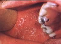 Tiny white spots in the mouth that are highly characteristic of the early phase of measles.  
Look like tiny grains of white sand. 
Found in the buccal mucosa opposite the 1st & 2nd MX molars.