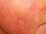 Spider veins in the face.  

Typically more in the elderly but = in males/females.