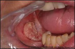Has a white marble appearance in the buccal mucosa. 

DD: lichen planus