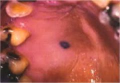 Nevus  

The hard palate is the most common intraoral site.