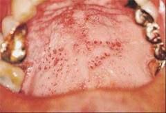 Hyperkeratosis on the palate with possible inflamed minor salivary gland ducts.  
(Looks like red or brown spots in the keratin)