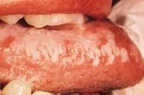 What disease states is Hairy Leukoplakia associated with?