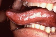 Lateral boarder of tongue, often is Bilateral!	

Won't wipe off!