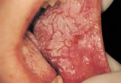 Most often bilaterally.  

No it won't rub off.  

Usually is located on the buccal mucosa.