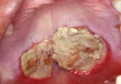 minor salivary gland necrosis related to (R/T) trauma
