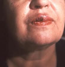 Primary-Chancre  
Secondary-Mucous patches  
Third-gumma-->can show up 10-20 years later.