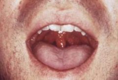 Pustular lesions on the tonsils & oropharynx