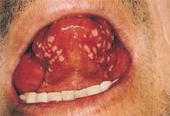 small would be 1-3mm but they can coalese into clusters of 10-100 ulcerations   
(They are smaller and more numerous than minor Apthous Ulcers AU's)