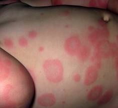 Blister, surrounded by red inflammed tissue with a lighter ring of edema surrounding it. (Give it a target look)