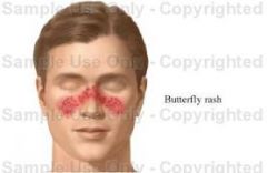 Butterfly distribution  

**Know this term is synomous with Lupus Erythematosus**