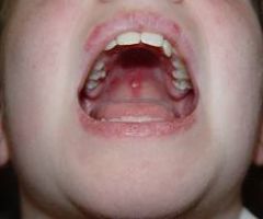 Eroded lesions, gingiva may be sluffing and erosive.  Erythematous (red)
