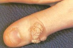 skin wart.  

Caused by HPV