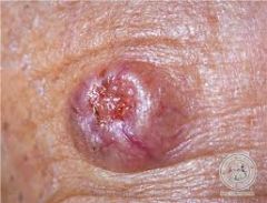 The Pearly Border!   
**Don't forget basal cell carcinoma is very slow growing.**