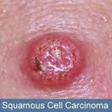 What is a key factor for squamous cell carcinoma?