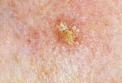 Actinic Keratosis!  

(Often seen in the lips where someone is chronically burning them.)