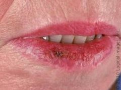 Lip mucosa (exposed to sunlight)  

**Has a blothcy apperance and smokers are more at risk!**