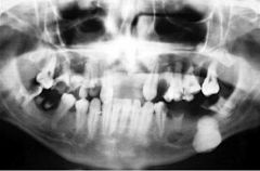 Ache in jaw, pain & swelling…may cause expansion of jaw
