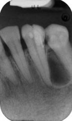 Cuspid & premolar areas-lateral surfaces of tooth