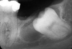 MN 3rd molars  MX canines   (These Unerupted Teeth)