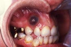 A painless cyst that forms in the gingival mucosa above the erupting tooth