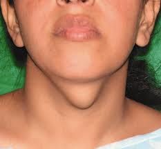 Thyroglossal track cyst  
(Tends to be non tender and mobile)