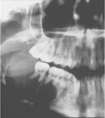 Ameloblastoma  
*Odontoma is the other "most common" one.*