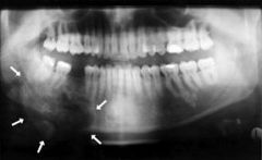 Premolar & molar region