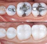 Amalgam to enamel	 
Comoposite (resin) to enamel  
*Remember, there is a chemical reaction happening. The attraction is between the different molecules of each surface.*