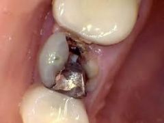 For badly broken down teeth before placing a crown.  

*Some contain pigment to contrast the color of tooth structure so its easier to place the crown…can see it better.*
