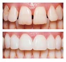 Will Not!  
They are very thin and the incisal edge usually wraps around to the lingual area.