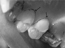 Posterior linguals, along the gingival margin…often found in clean mouths.	  

Females