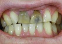 A stain in a pulpless tooth is considered what classification?  Why?
