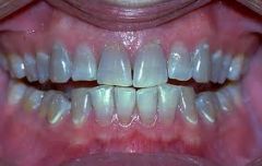 Teeth with enamel but no dentin!  
The dentin may be irregular