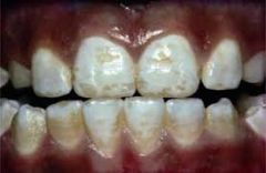 Dental Fluorosis is caused by the excessive ingestion of fluoride while teeth are forming.  What is the classification of stain?