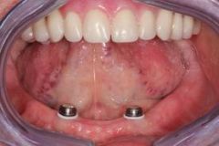 A removeable prosthesis that tests on one or more remaining natural teeth, roots and/or dental implants.