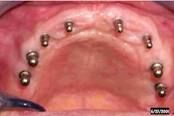 More Common!   
It uses actual implants in the edentulous Pt to hold the denture in place