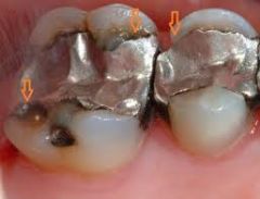 The overhang requres excessive time to reshape  Recurrent caries is present  
Contact is no longer intact   
Margins are fractured, chipped or cracked.