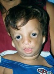 Receding Chin   
Hypoplasia or absence of zygomatic process   
Abnormal or misplaced ears  
Fishlike mouth   
Lower eyelids have a cleft   
(Pt's often have difficulty hearing.)