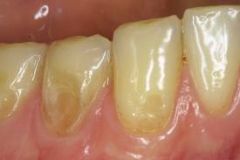 The pathologic loss of tooth structure (chemical in nature)