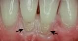 The pathologic wearing away of tooth structure due to external factors..toothbrushing, hair pins etc.