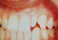 mis formed or conical shaped MX lateral incisors.  
*Both primary and perm teeth can be affected.*