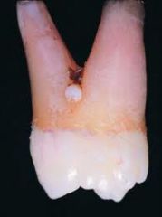 On the buccal or lingual surface of the MX molars  (Remember, it’s a small projection of enamel seen on the root surface.)