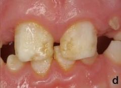 Type I Hypoplastic  
*The ameloblasta malfunction and the enamel is not formed properly or of normal thickness.*