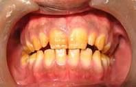 Type II Hypocalcified  
*This situation will leave exposed dentin which will stain easily*