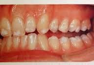 Hypomaturation-->the enamel is of normal thickness but is mottled.