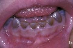 Bulbous crowns w/opalescent brown to bluish hue.  *Attrition can be severe*