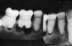 Dentin Dysplasia